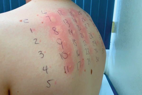 Skin prick test on a person's back