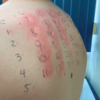 Skin prick test on a person's back: Skin prick test on a person's back